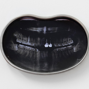 Dental Trauma (Upper Quadrant)